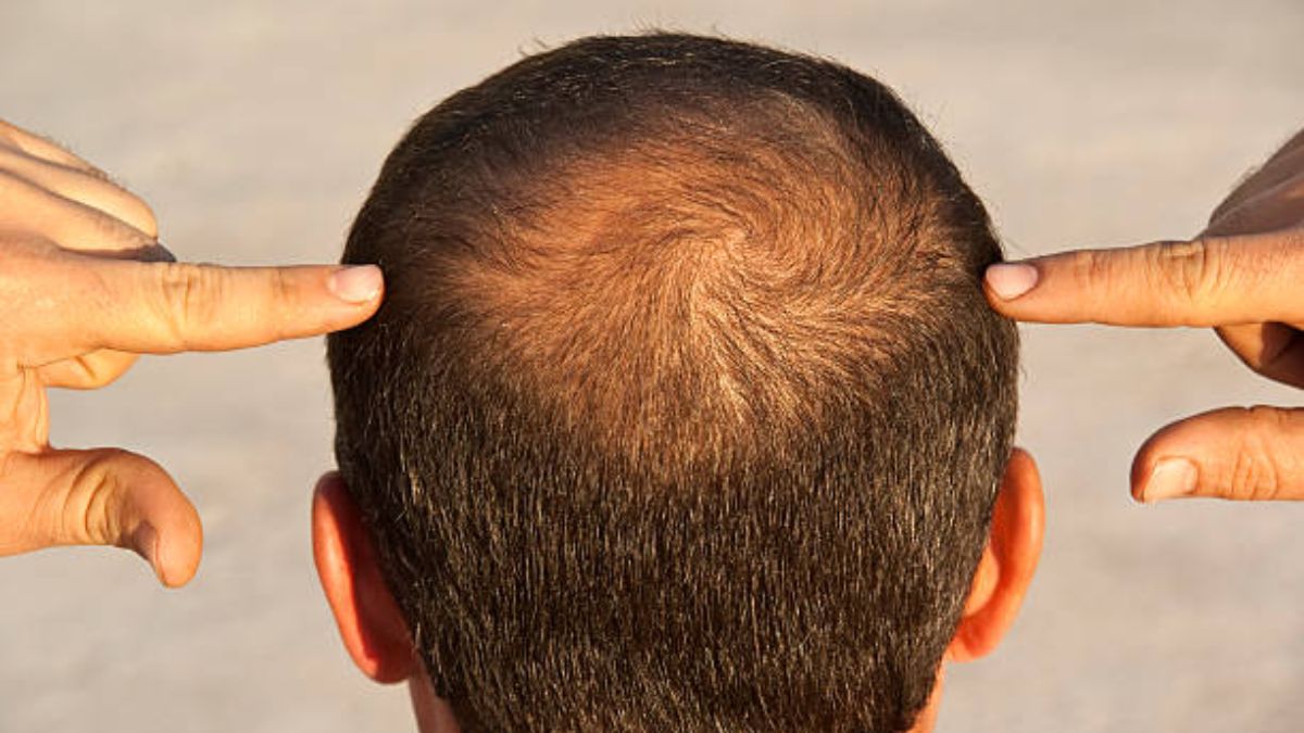 Hair mistakes causing hair loss