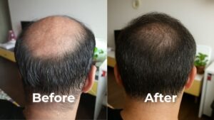 reverse male-pattern baldness