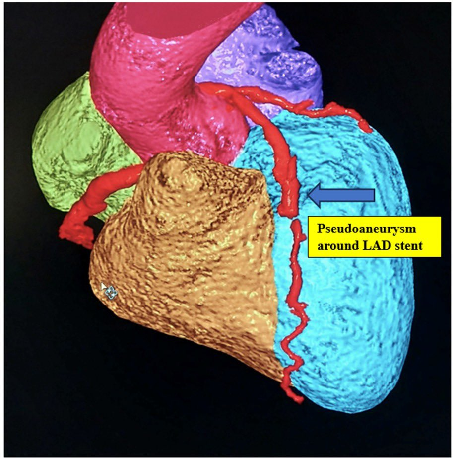 AICTS Pune doctors successfully treat four patients with ultra-rare coronary stent infections