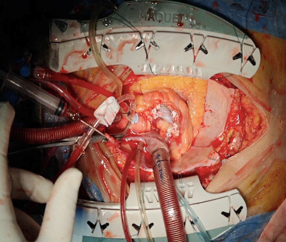 AICTS Pune doctors successfully treat four patients with ultra-rare coronary stent infections